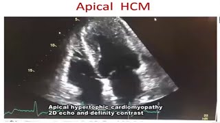 Cardiomyopathy Echo by Prof Dr Tuhin Haque madam [upl. by Nivk]