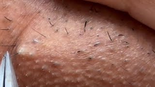 INGROWN HAIR REMOVAL 102  Longest Plucking Video Yet  DermaplaningEyebrow Shaving [upl. by Ranita]