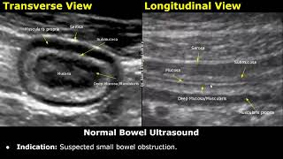 Small Bowel Ultrasound Reporting  How To Write USG Report  Bowel Obstruction Crohns Disease [upl. by Gearalt]