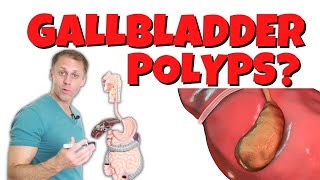 Why Do I Have Gallbladder Polyps [upl. by Dlaregztif726]