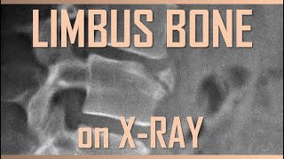 Limbus Bone bones spine [upl. by Htebi]