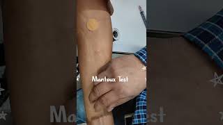 Mantoux Test  Tuberculin Skin Test  TBTest infectionBodyMTBPCRTBGOLD [upl. by Baxy]