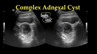 Complex Adnexal Cyst  Ultrasound  Case 27 [upl. by Forrest]