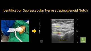 Ultrasound Guided Suprascapular Nerve Block at Spinoglenoid Notch and Glenohumeral Joint Hydrodilati [upl. by Barlow105]