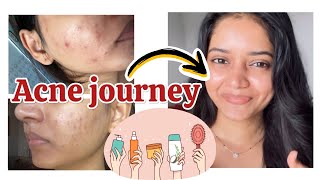 Severe ACNE cure journey in budget🥰❤️🤑 [upl. by Cohe409]