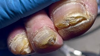 Thick nails every toenail infected with onychomycosis【Pedicure Master Lin Jun】 [upl. by Hapte558]