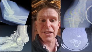 case takeaway Wrightington elbow fracture dislocation classification with Adam Watts [upl. by Hahcim]