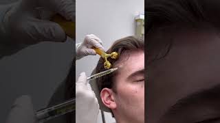 PRP treatment for hair thinning [upl. by Koller18]