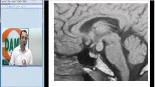 Hypothalamic Hamartoma Radiology Spotter Series37 By Dr Sumer Sethi [upl. by Eecak]