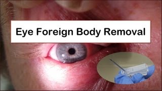 Eye Foreign Body Removal [upl. by Deny]