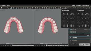 Invisalign First Before and After [upl. by Dario992]