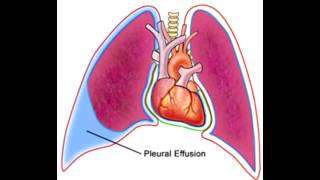 Pleural Effusions  Transudate Exudate amp Lymphatic [upl. by Eiramaliehs]