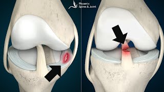 Is your knee pain coming from an ACL tear or Meniscus injury How to tell [upl. by Charlton]