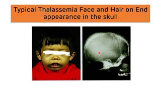 Beta Thalassemia and Alpha Thalassemia  Types Diagnosis and Treatment  Thalassemia Major amp Minor [upl. by Yerocaj107]