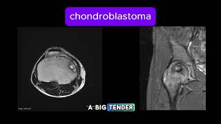 Chondroblastoma [upl. by Griselda]