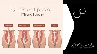 Diástase Abdominal Como funciona a Correção de Diástase por Cirurgia Robótica [upl. by Isabella]