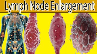 Lymph Node Enlargement  7 Most common causes [upl. by Leila320]