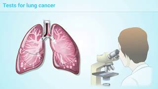 What is Lung Cancer [upl. by Templeton500]