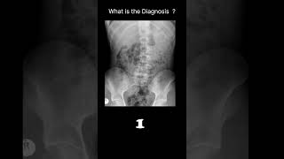 Appendicolith Abdominal Xray  Abnormal calcification 54 radiologychannel007 [upl. by Lamahj]