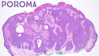 Poroma Dermpath in 5 Minutes dermatology pathology dermatopathology board review [upl. by Annaer]