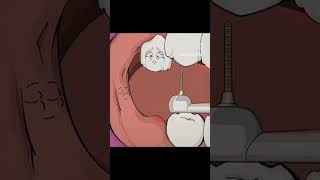 Third molar extraction [upl. by Haraj]