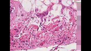 Histopathology Heart pericardiumMetastatic breast carcino [upl. by Enahs]