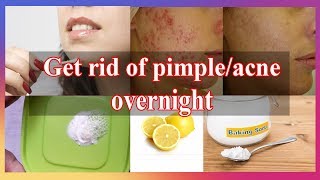 Get rid of pimples overnight  Acne spot treatment  Lemon and Baking soda [upl. by Ahseneuq]