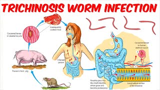 Trichinosis Trichinellosis Worm Infection [upl. by Enilehcim]