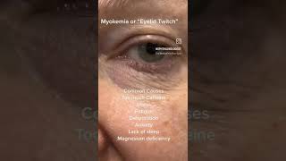 Myokymia or eyelid twitch youtubeshorts science medicalstudent shortsfeed biology [upl. by Yetta]