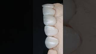 Maquillaje borde incisal disilicato de litio esteticadental dentist diente aidite [upl. by Wheaton]