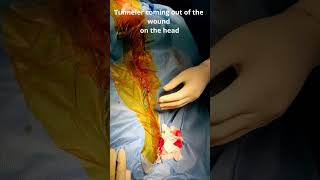 How We pass VP shunt tube beneath the skin with 2 small openings Neurosurgery OT VP shunt operation [upl. by Spatola]