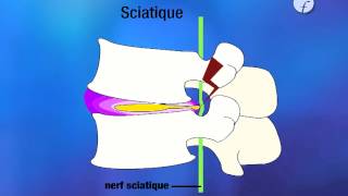 Vidéo pédagogique quotPrévention des risques liés à lactivité physique Industrie quot  Les pathologies [upl. by Jeri836]