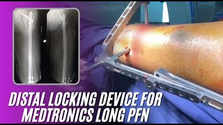 DISTAL LOCKING JIG FOR METRONICS LONG PFN LIVE DEMONSTRATION IN A CASE OF INTER TROCHANTER FRACTURE [upl. by Bertrando]