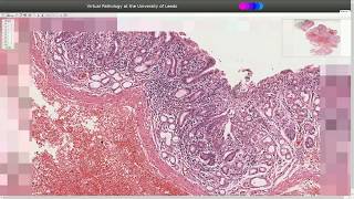 Histopathology  Dieulafoy Lesion  Stomach [upl. by Abel51]