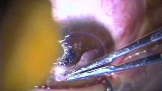 Transplante lamelar de cornea [upl. by Krisha]