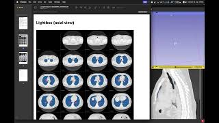 Segmentação e Análise do Parênquima pulmonar no 3D Slicer [upl. by Emoryt]