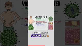 Pathogenesis of Varicella Zoster Virus microbiology101 bacteria virology chickenpox [upl. by Jarrad268]