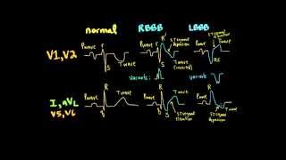 Schneid Guide to Bundle Branch Blocks [upl. by Adli928]