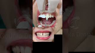 Trámcomposite nhakhoacodofa veneerfromvietnam veneers smile topdental răngsứthẩmmỹ dentist [upl. by Older]