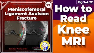 Fig 3A22 Meniscofemoral Ligament Avulsion Fracture [upl. by Anivek80]