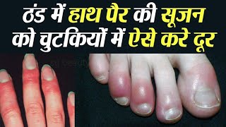 ठंड से हाथ पैरों की उंगलियों मे सूजन व खुजली के घरेलू इलाज़ Home Remedies for Chilblains Perniosis [upl. by Ozner]