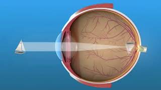 What is Refractive Error [upl. by Erotavlas]