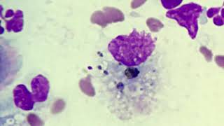 Alveolar macrophages with phagocytised debris [upl. by Kyd]