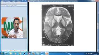 Radiology Spotters Part 27 Glutaric Aciduria Type I Dr Sumer Sethi [upl. by Aron]