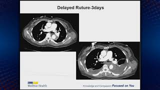 Treatment Options For PAU And IMH [upl. by Adnawaj]