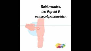 Fluid retention  edema  low thyroid [upl. by Sacram]