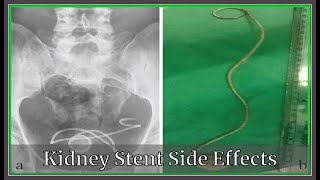 Kidney Stent Side EffectsKidney deseases Very Well [upl. by Enreval]