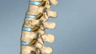 Spine Surgery Croatia  Vertebroplasty [upl. by Adlesirk]