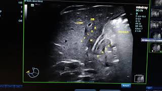 Hypertrophic Pyloric Stenosis HPS [upl. by Tedman527]