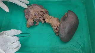 spleen pancreas and duodenum  ABDOMINAL VISCERA EXPLAINED  MBBS 1ST YEAR ANATOMY  DISSECTION [upl. by Stormi]